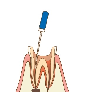 POINT 歯科用根管拡大装置（Xスマート）