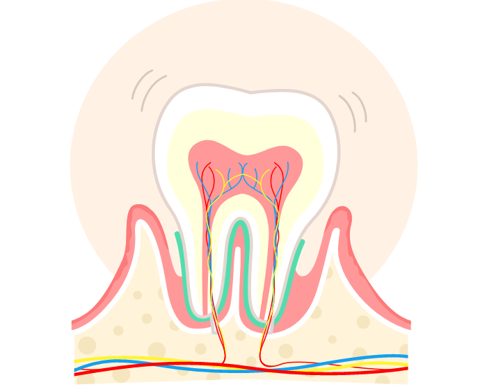 中度歯周病（歯周炎）の場合