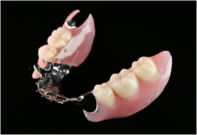 ノンクラスプデンチャー+金属床